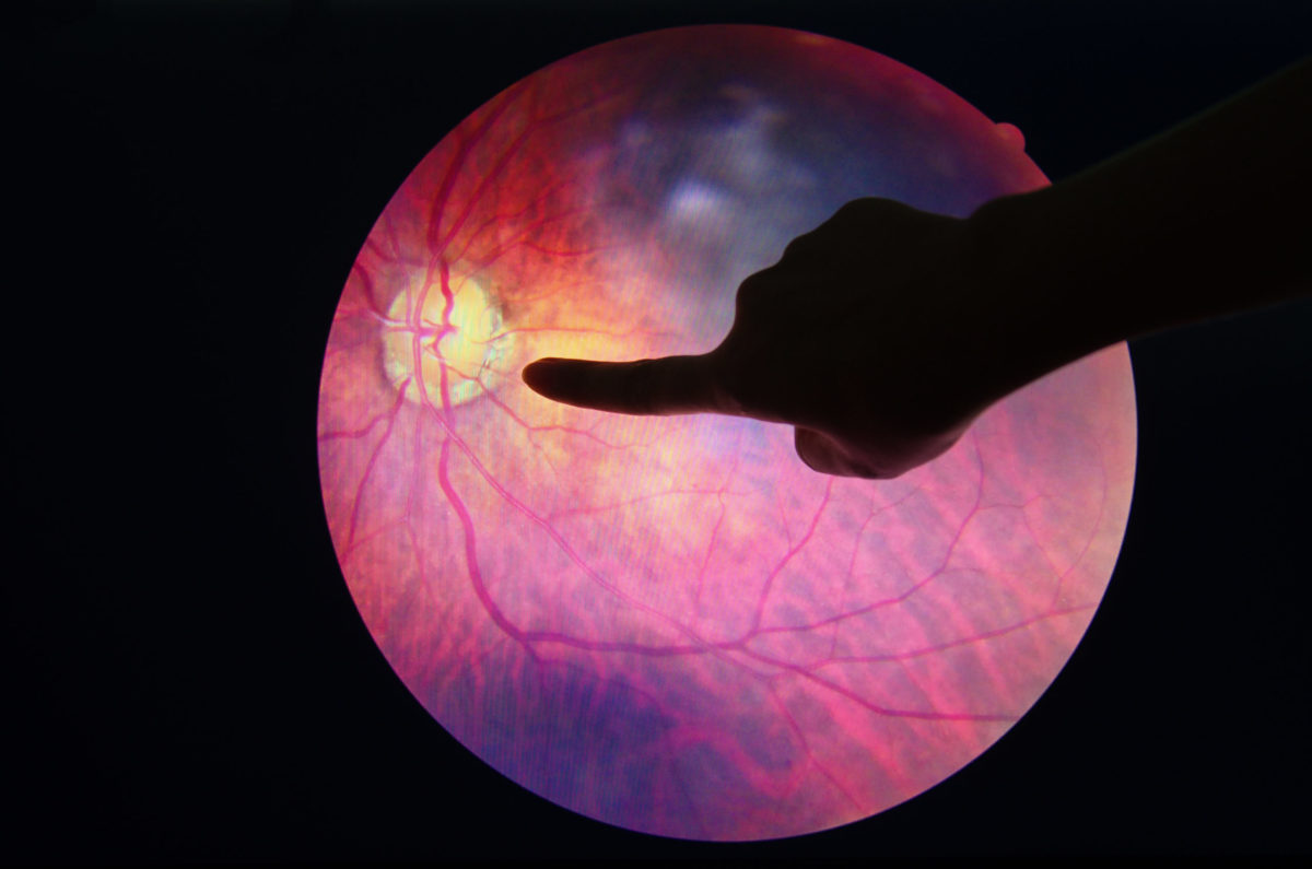 Hand pointing to eye scan on diabetic retinopathy